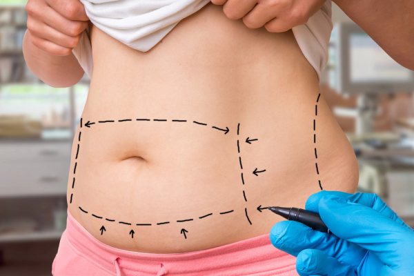 Entenda as Diferenças Entre os Tipos de Lipoaspiração: Tradicional, HD e Novas Tecnologias