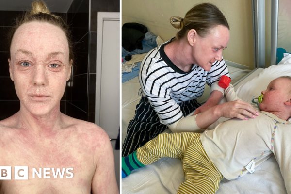 Controvérsia Médica: Retirada de Esteroides Tópicos e o Mistério do TSW