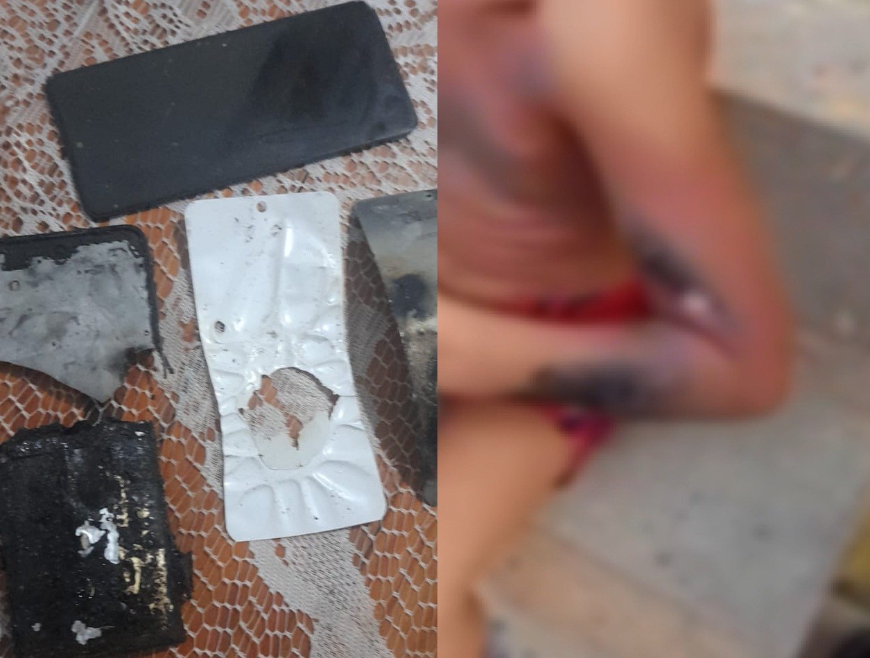 Criança de 6 anos sofre queimaduras após celular explodir no Recife